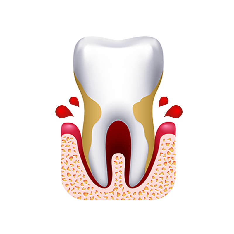 Patient with severe bleeding on gums